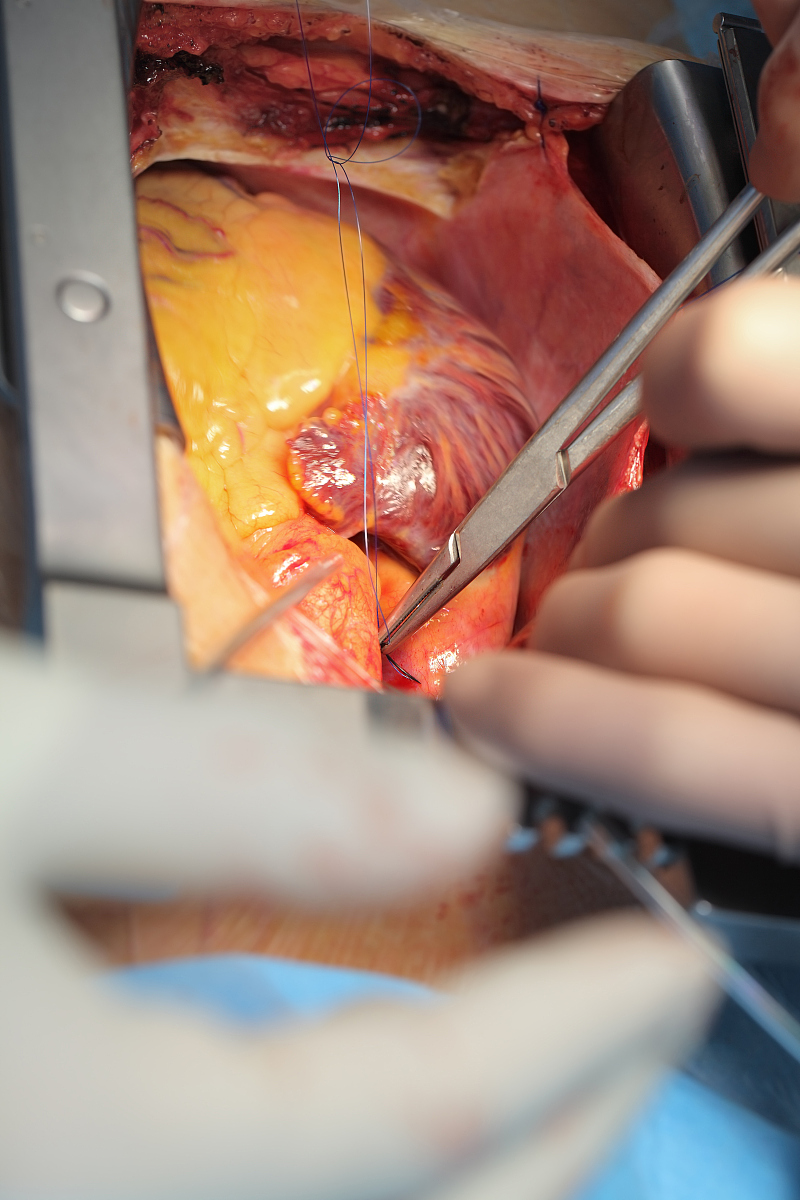 suturation of heart during surgical process