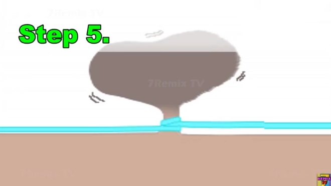 脖子 腋下长的小肉球球「皮赘」,用绳子系掉的原理展示,不推荐