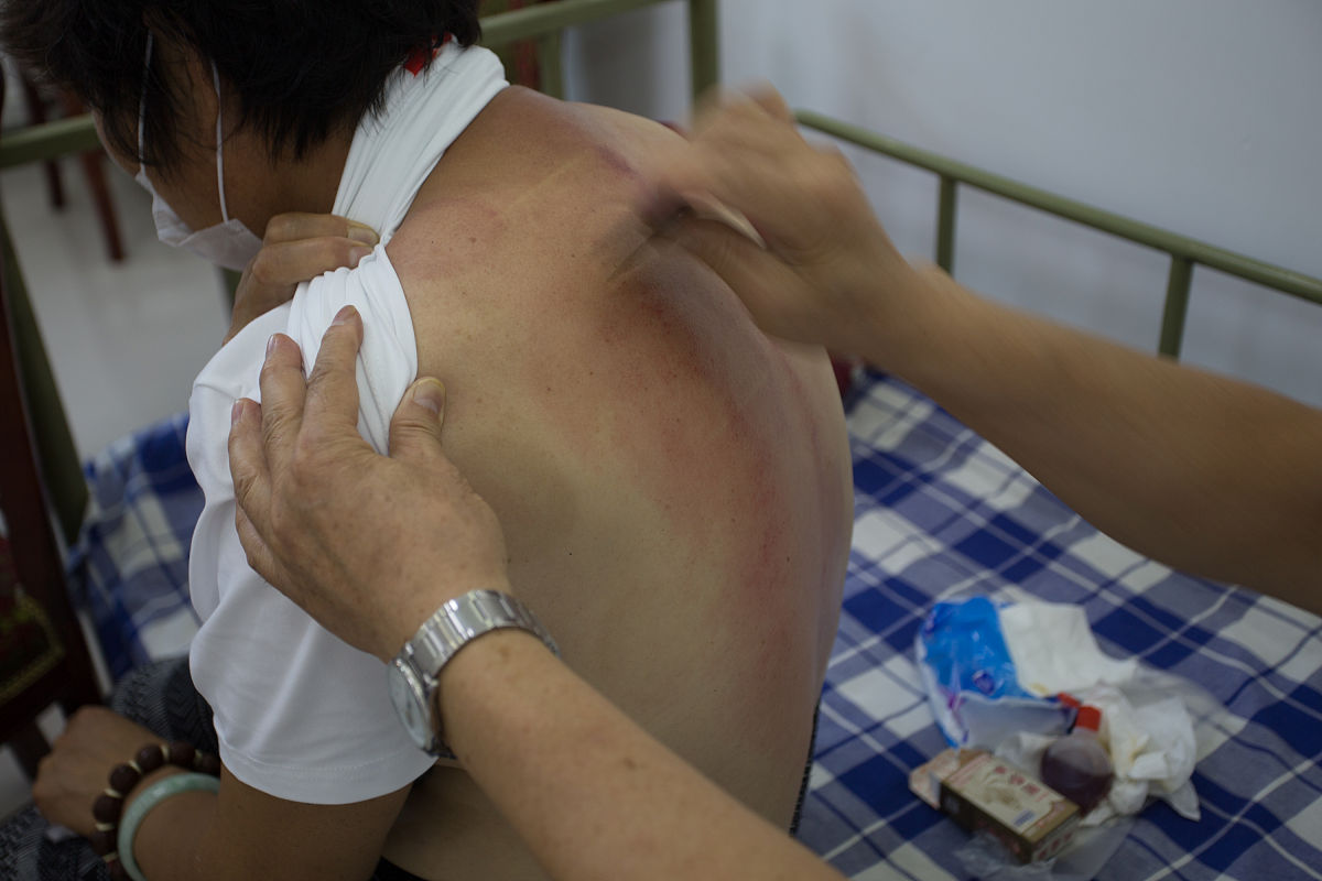 刮痧可以天天做吗？专家解析不同维度答案！