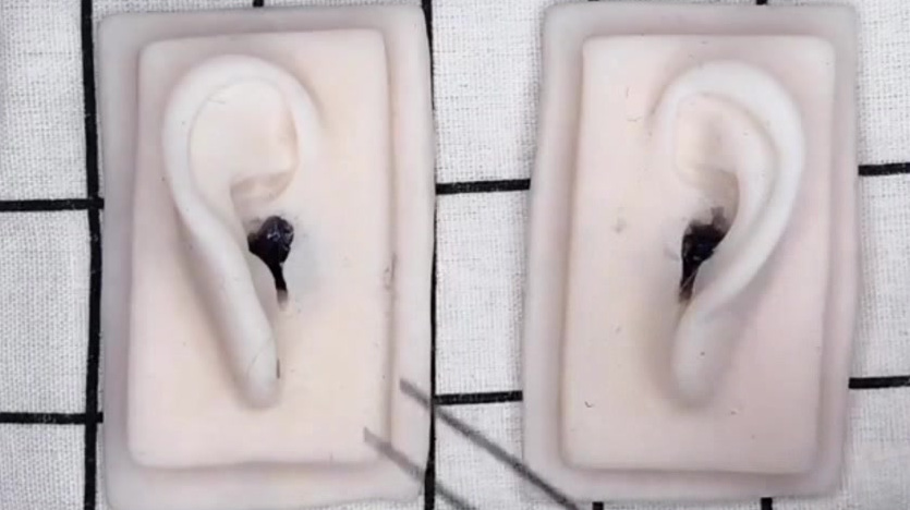 挖耳屎耵聍视频