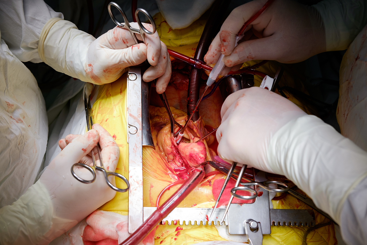 surgeons operating during cardiac operation of cabg
