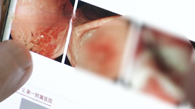 【男孩吃饺子吞下2枚硬币1年后取出 已腐蚀变黑】#健康过大年# 近日,河南新乡一男孩肚子疼