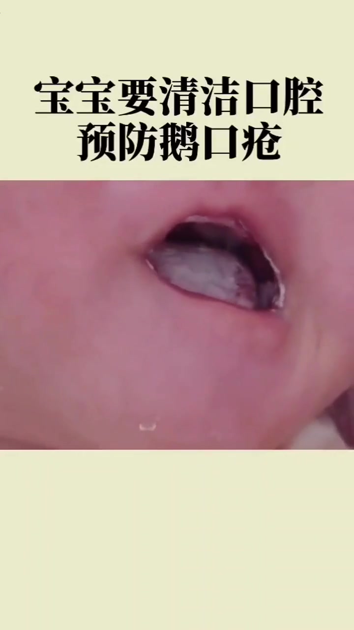 鹅口疮是白色念珠菌感染引起的擦不掉的白色