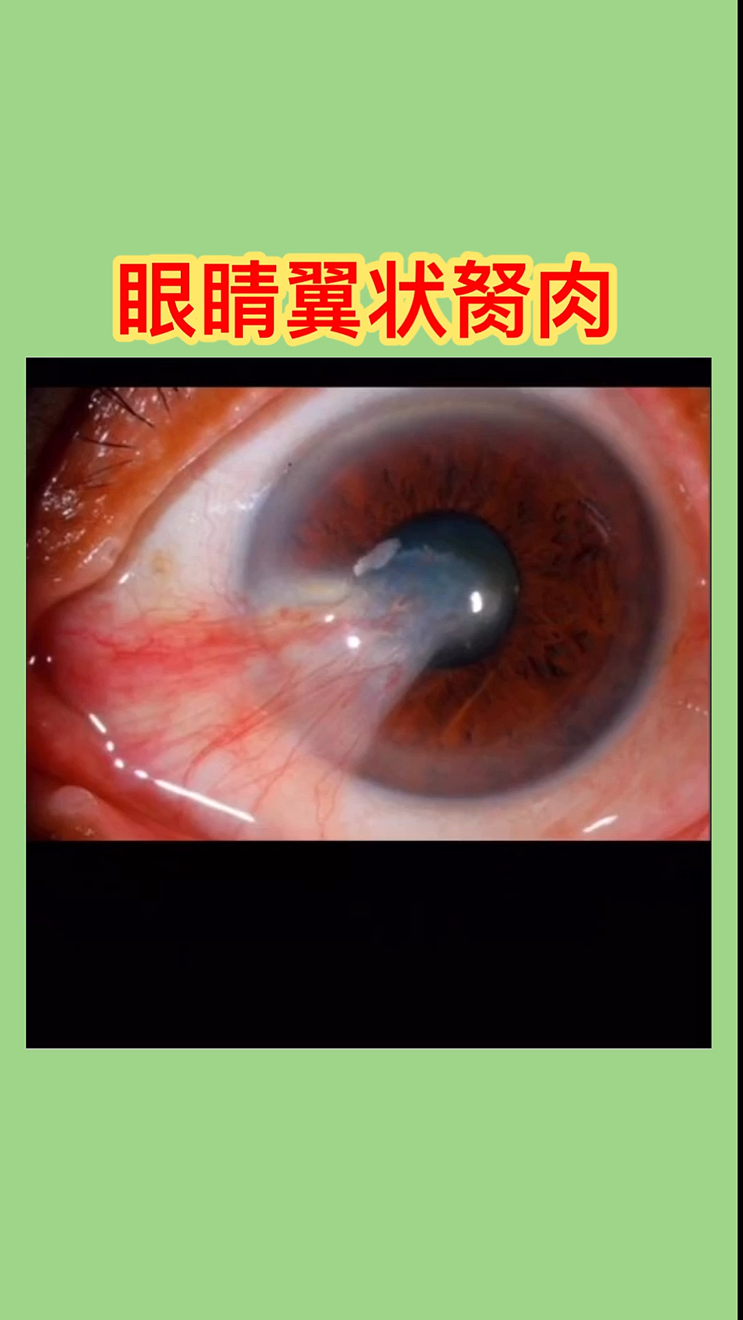 你的眼睛有这种情况吗?