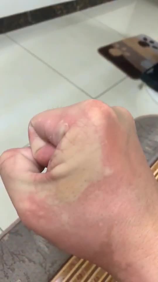 过敏,是这个样子的,全身奇痒无比,因为密恐其他就不发了,就因为我吃了几只小虾,晚餐喝的粥和
