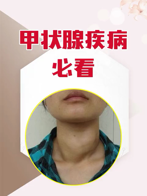 甲状腺疾病不可怕,可怕的是你不知道什么能吃,什么不能吃