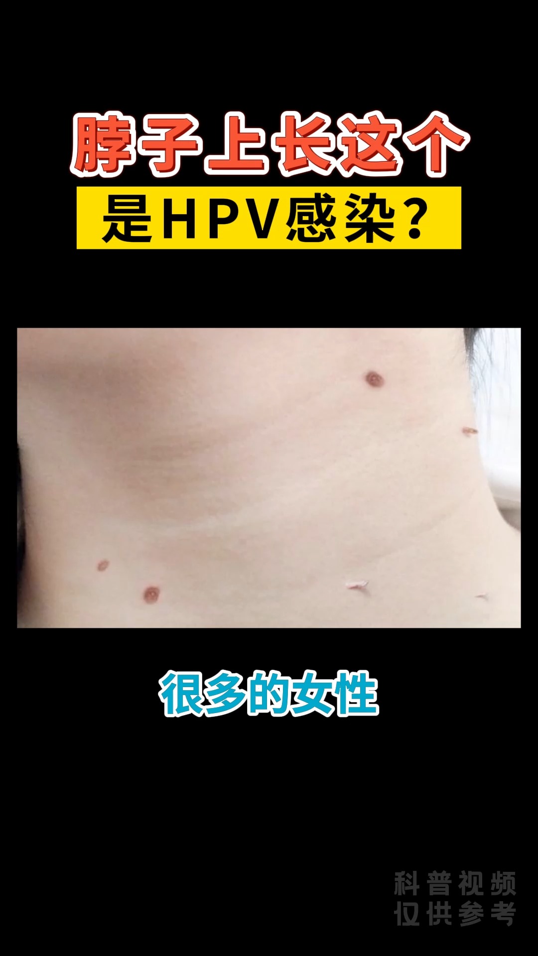 皮肤上长这个是hpv感染吗?怎么办?