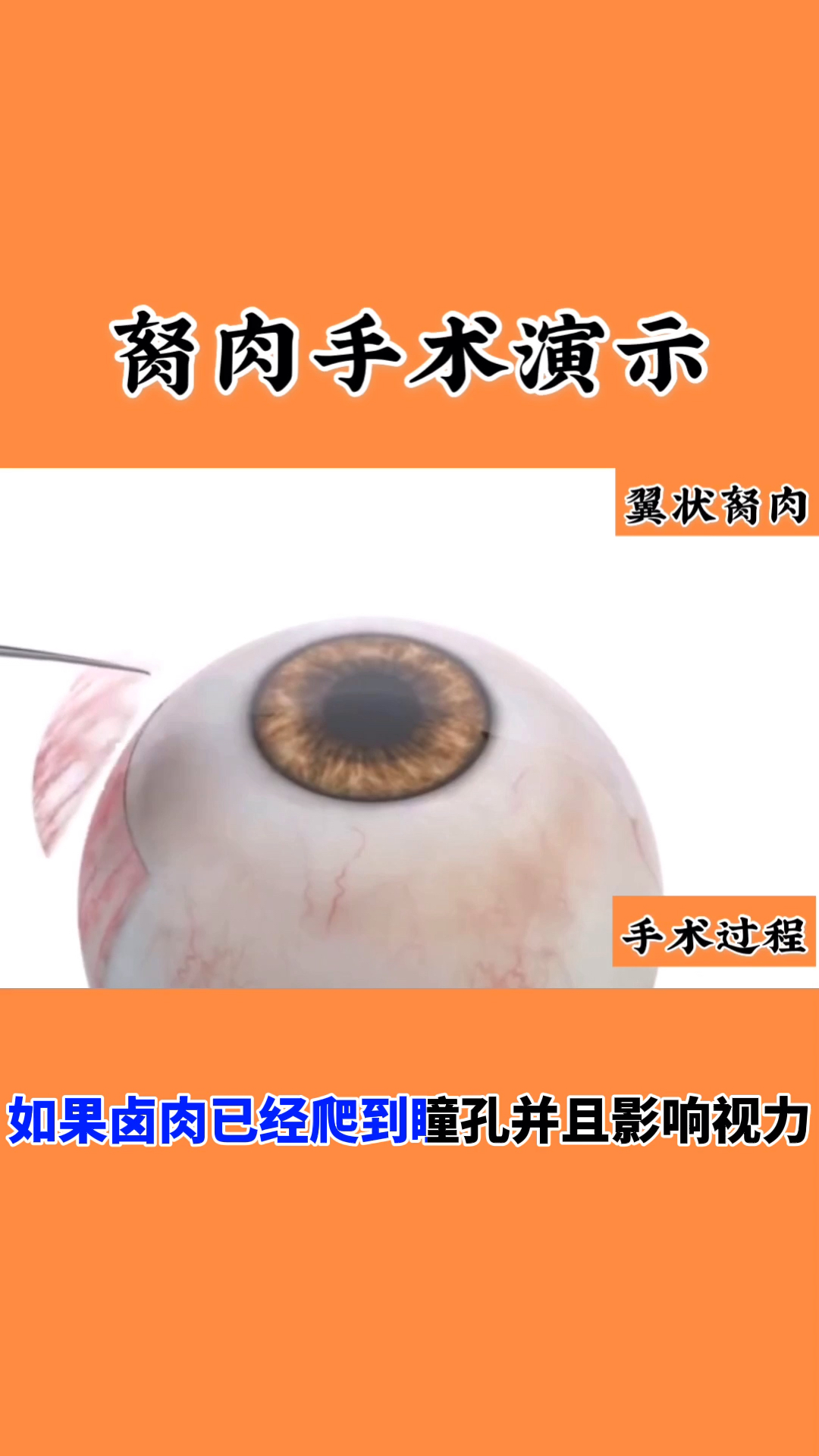 #保护眼睛#胬肉手术演示