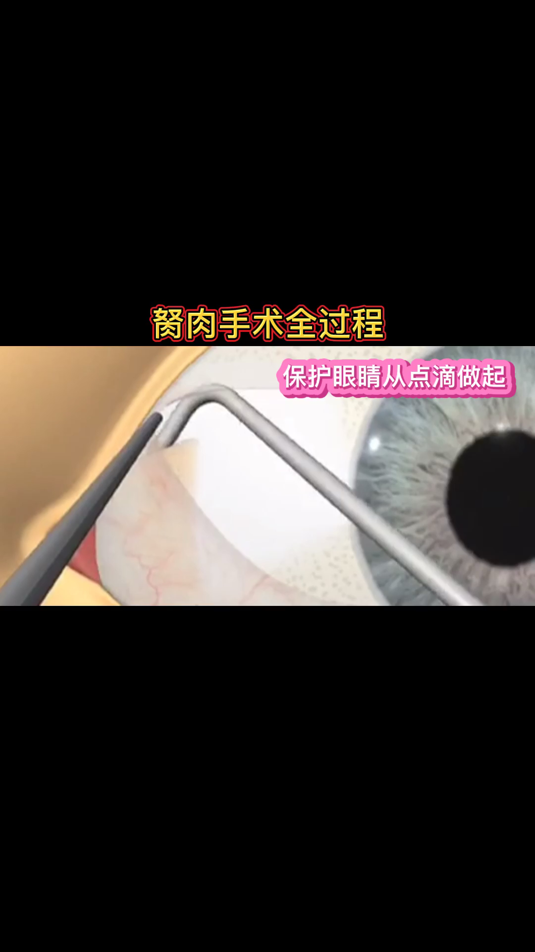 #护眼知识#护眼知识  翼状胬肉,保护眼睛冲点滴做起