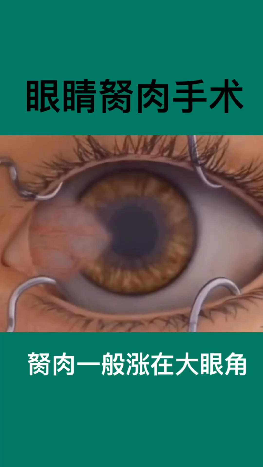 #我要上热门!#眼睛胬肉你了解过吗