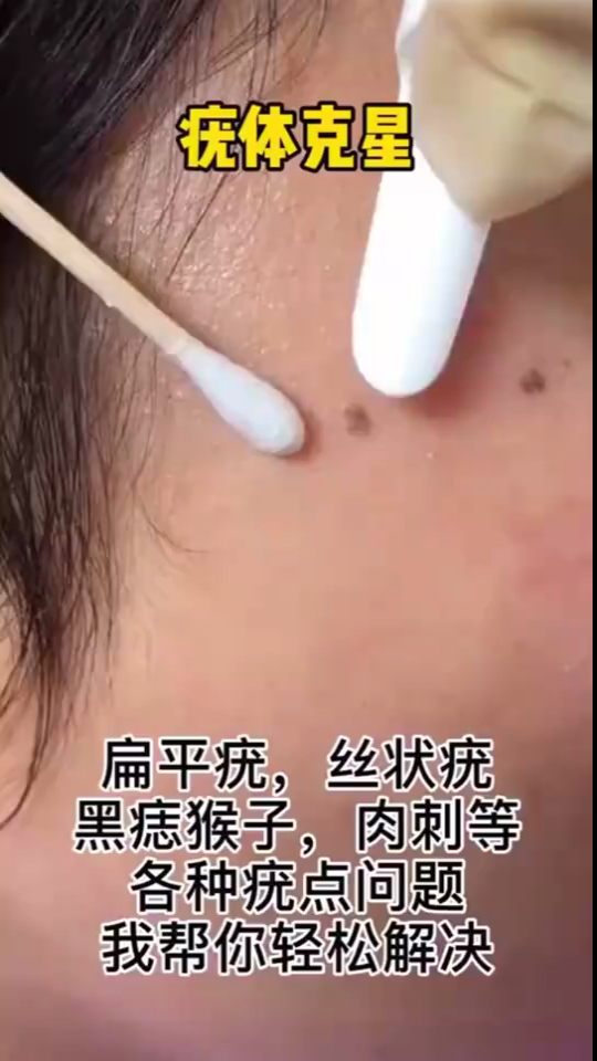 疣体克星。扁平疣,丝状疣黑痣猴子,肉刺等各种疣点问题我帮你轻松解决
