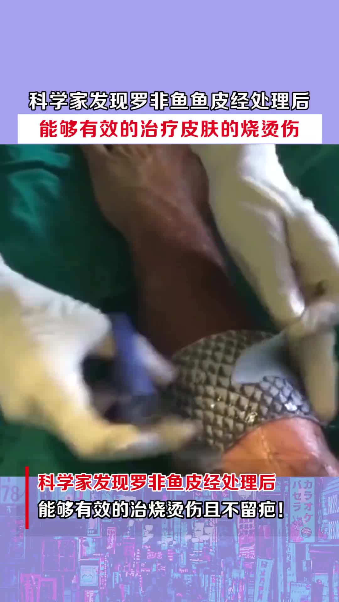 科学家发现罗非鱼鱼皮经处理后,能够有效的治疗皮肤的烧烫伤!