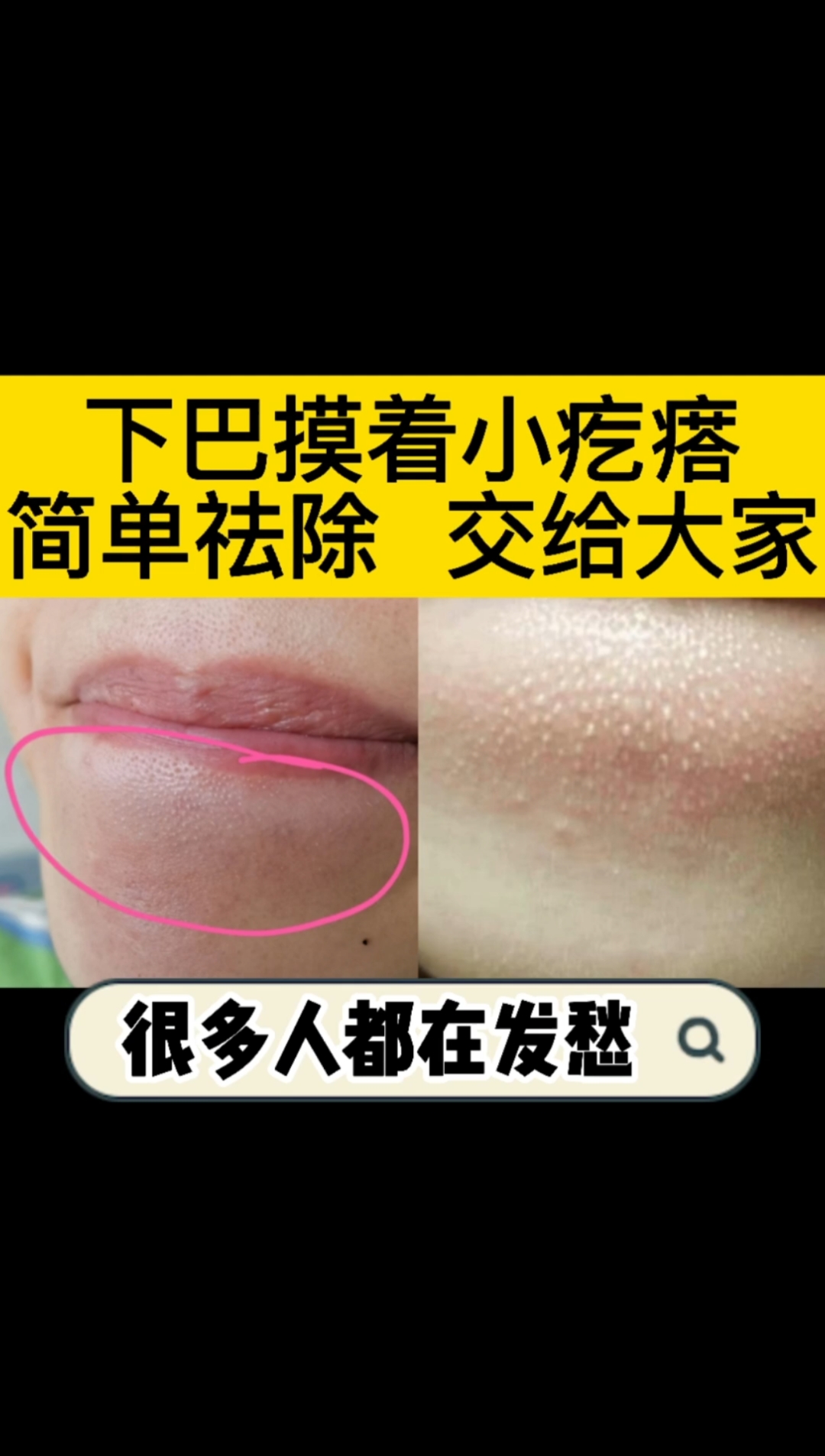 #每天一点冷知识#下巴小疙瘩,我们来讲清楚!