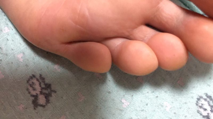 鸡眼 跖疣