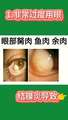 眼睛胬肉鱼肉余肉改善眼疾