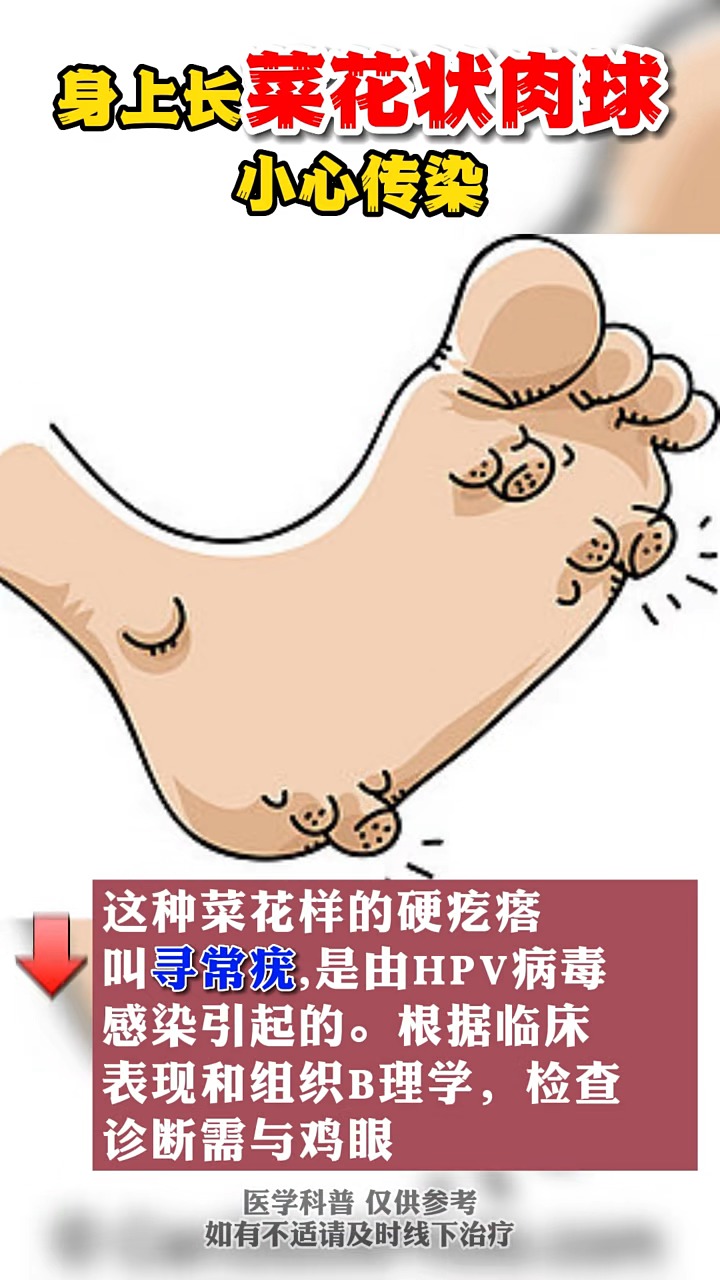 #关爱女性健康#身上长菜花状肉球小心传染