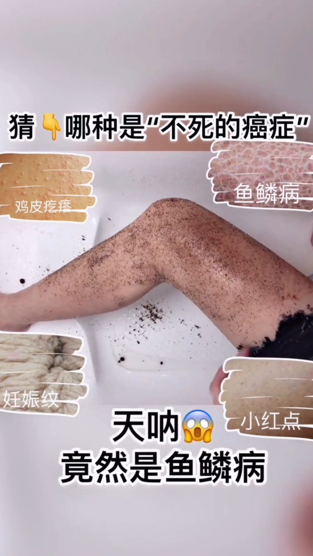 夏天最可怕的皮肤  也是最尴尬的皮肤