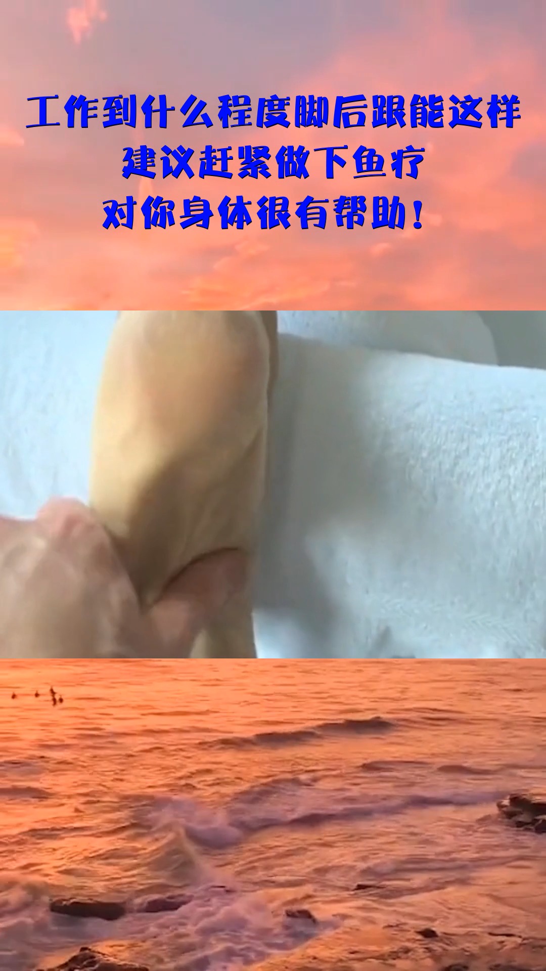 工作到什么程度脚后跟能这样,建议赶紧做下鱼疗,对你身体很有帮助!