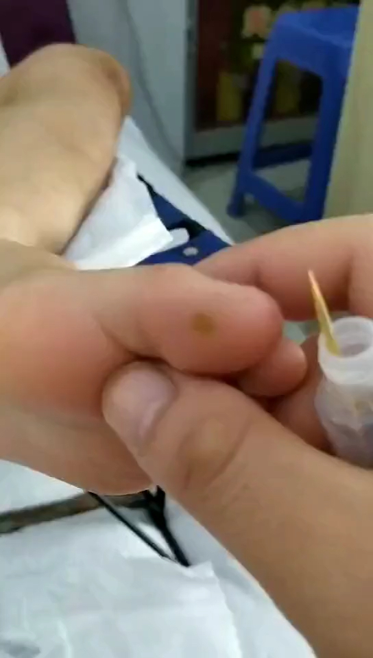 跖疣鸡眼