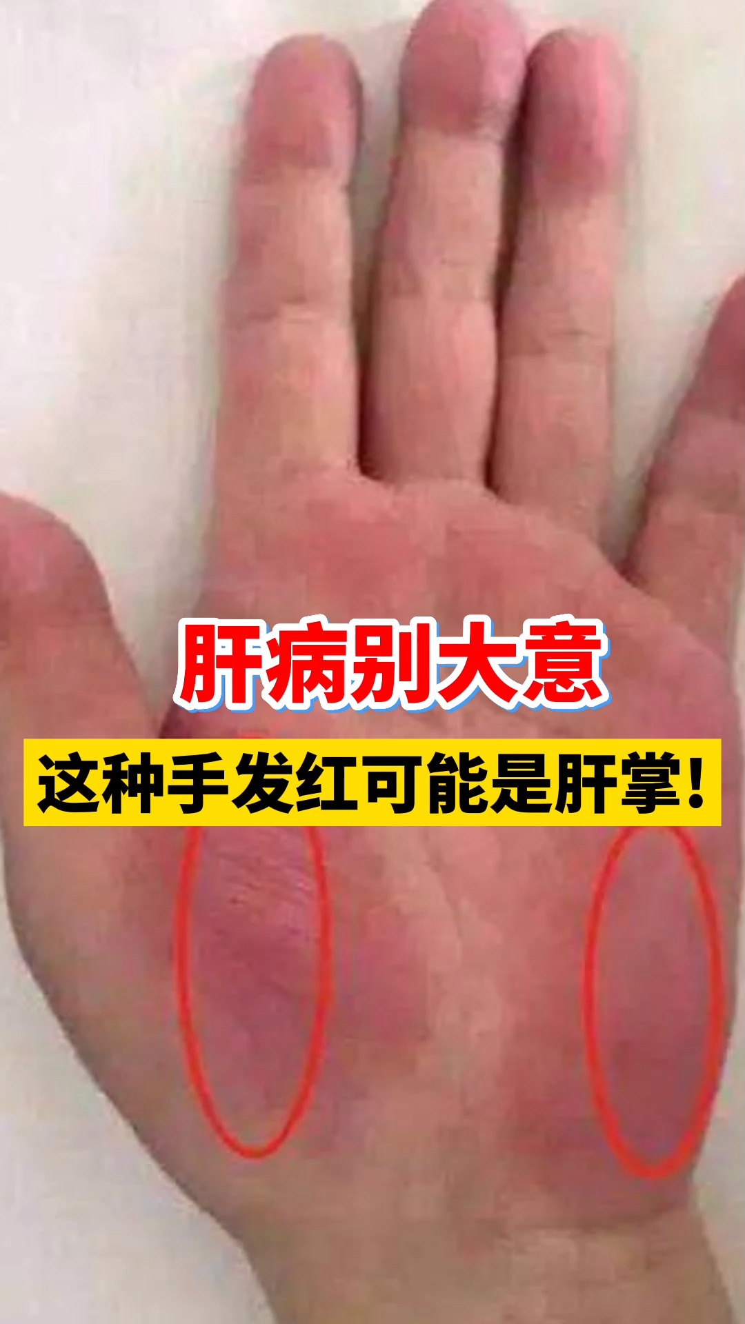 肝病别大意,这种手发红可能是肝掌!