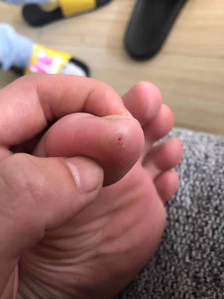 不是鸡眼