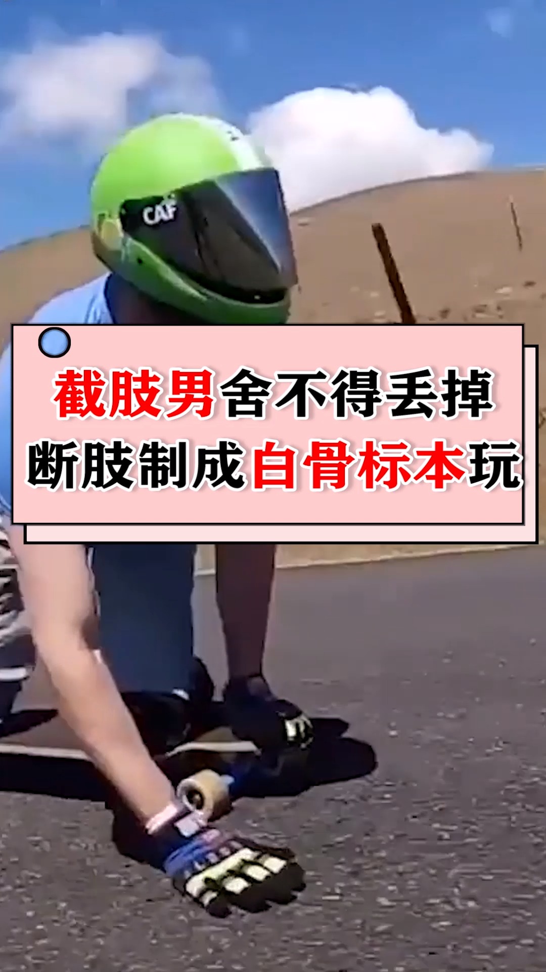 加拿大截肢男舍不得丢掉断肢,让虫子啃肉后,制成白骨标本玩