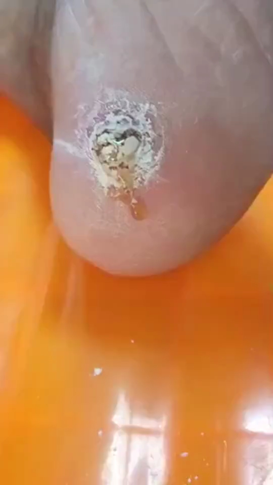 鸡眼