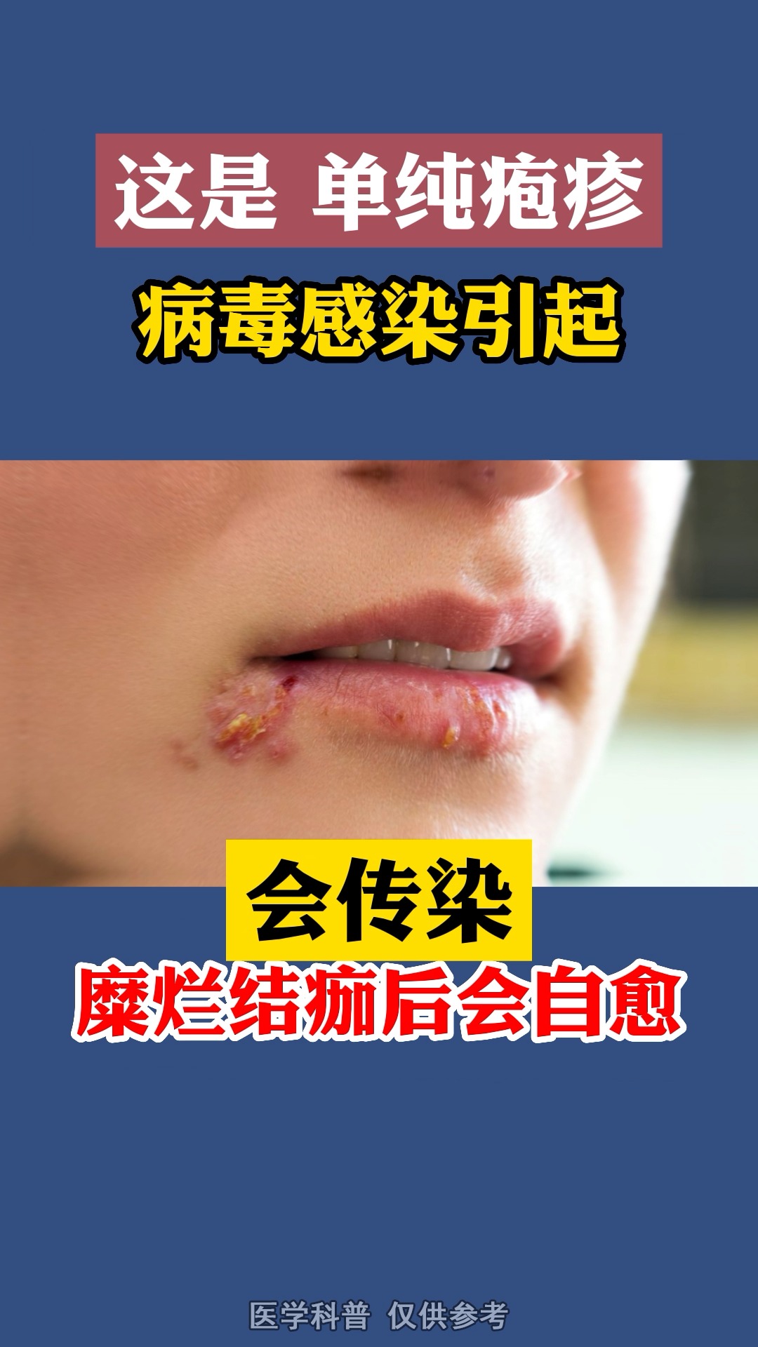 #疱疹#嘴上这种水疱会传染,不要亲宝宝!
