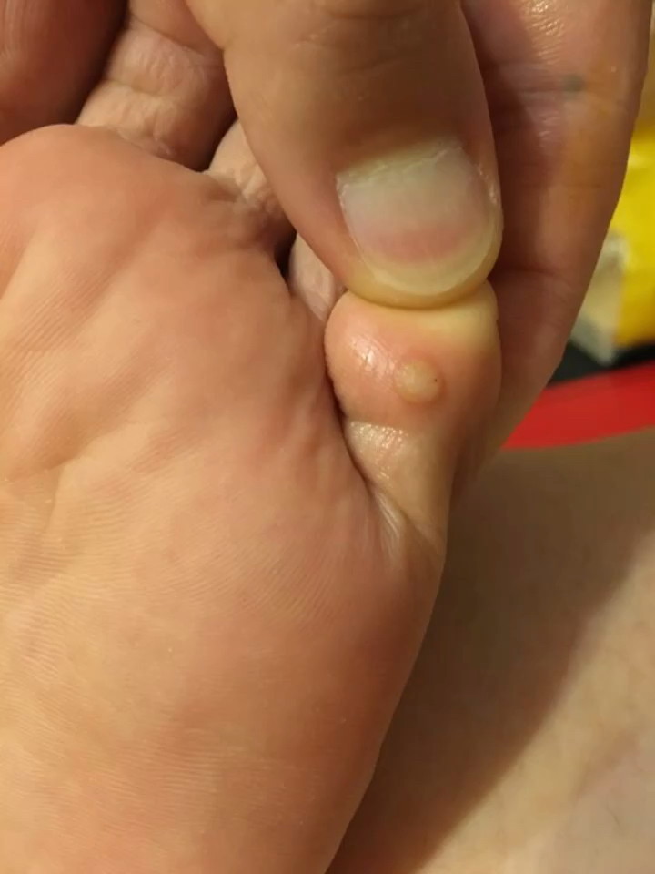 这不是鸡眼