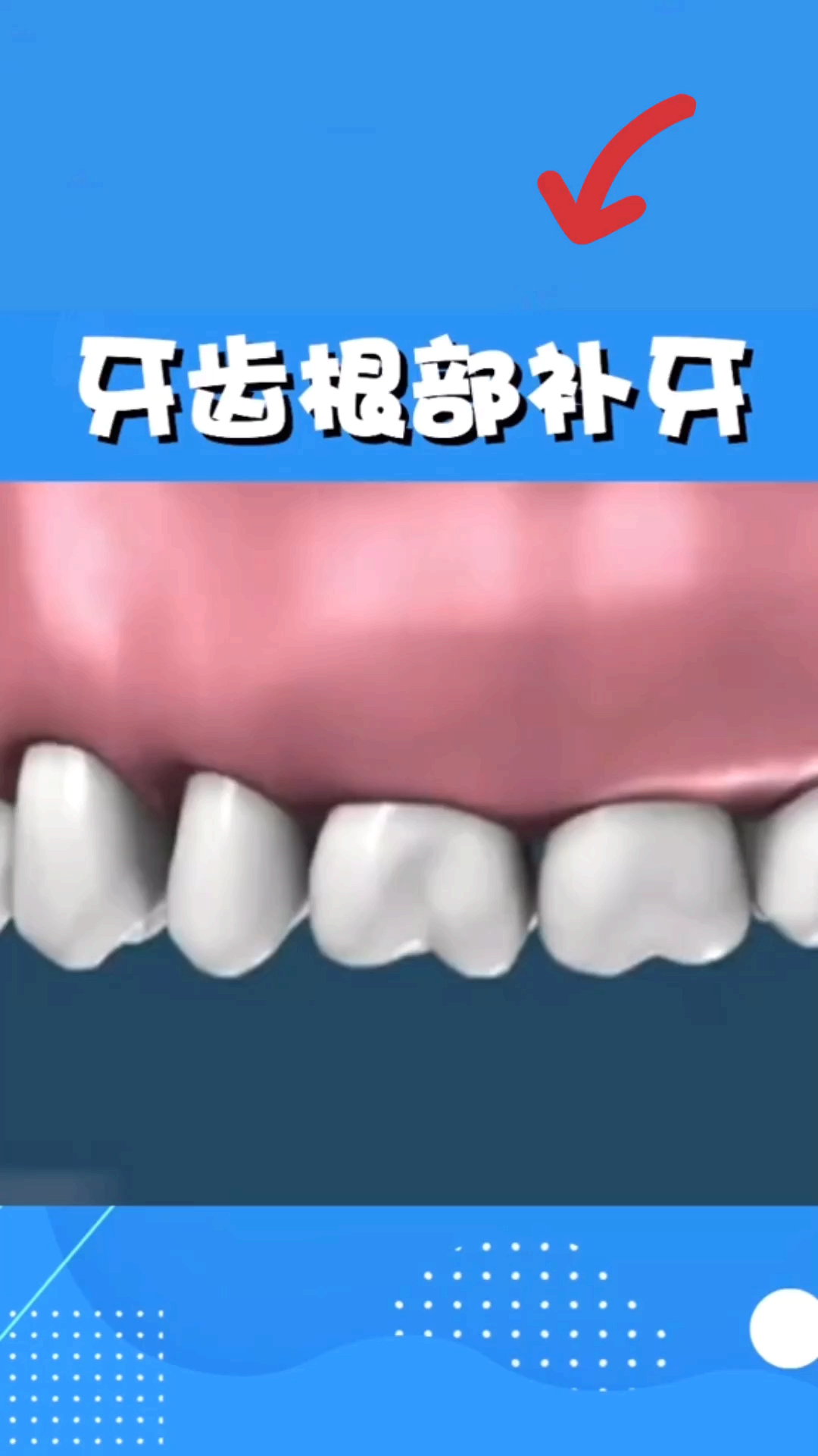 #嘴角向上笑一个吧#牙齿根部缺损,要怎么处理呢!