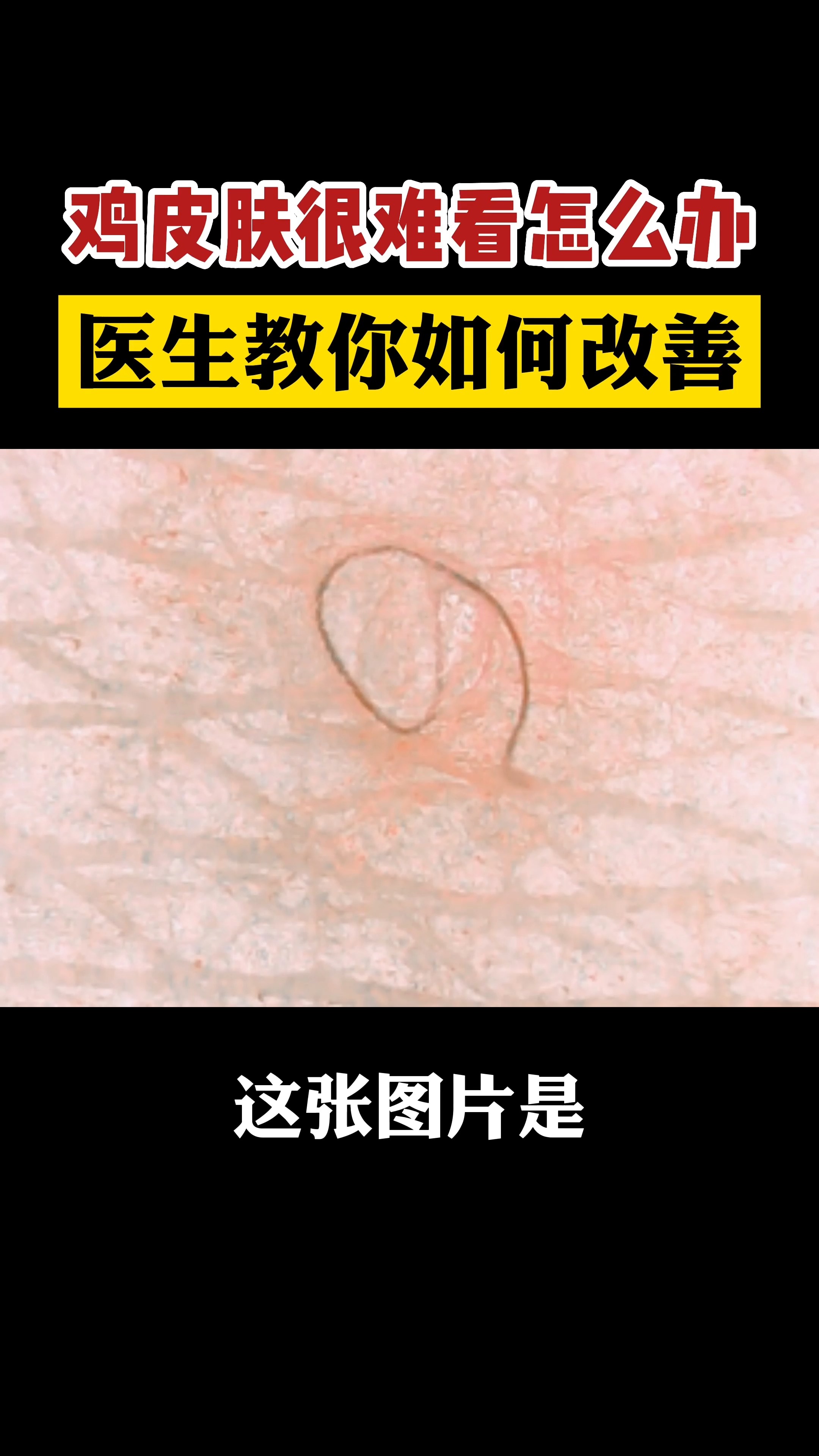 #健康科普#鸡皮肤很难看怎么办,医生教你如何改善