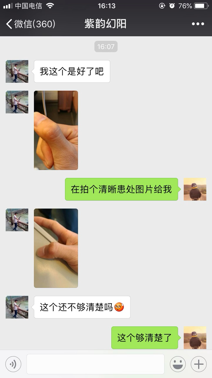 瘊子不要乱贴鸡眼膏