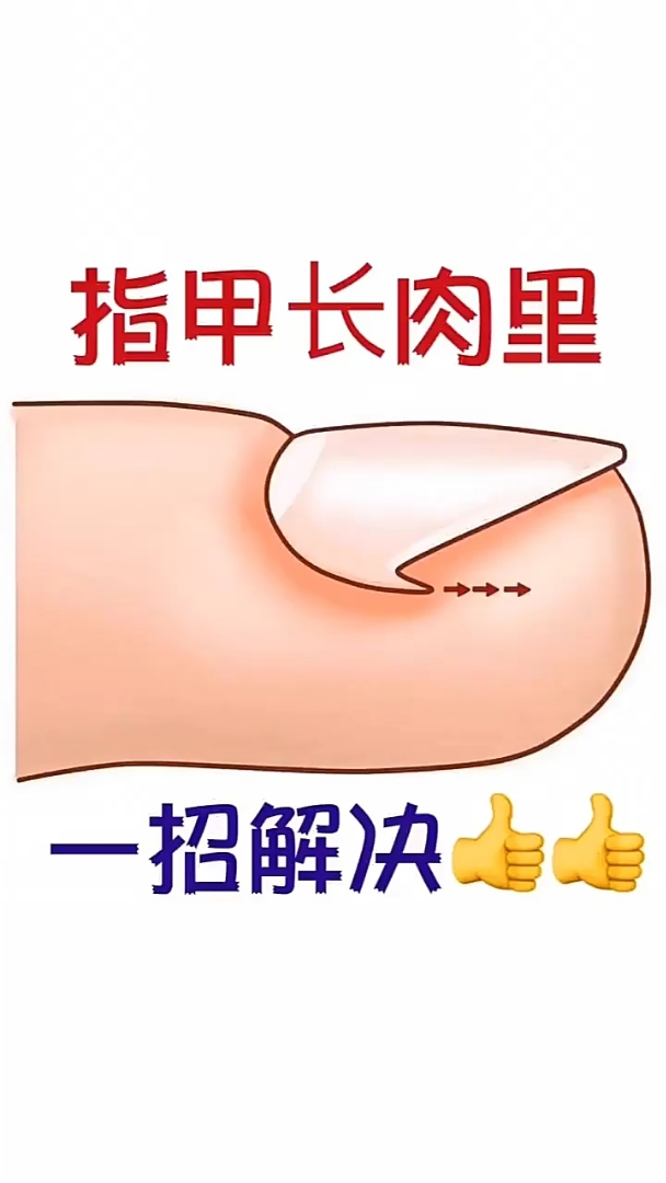 指甲长肉里。一招解决