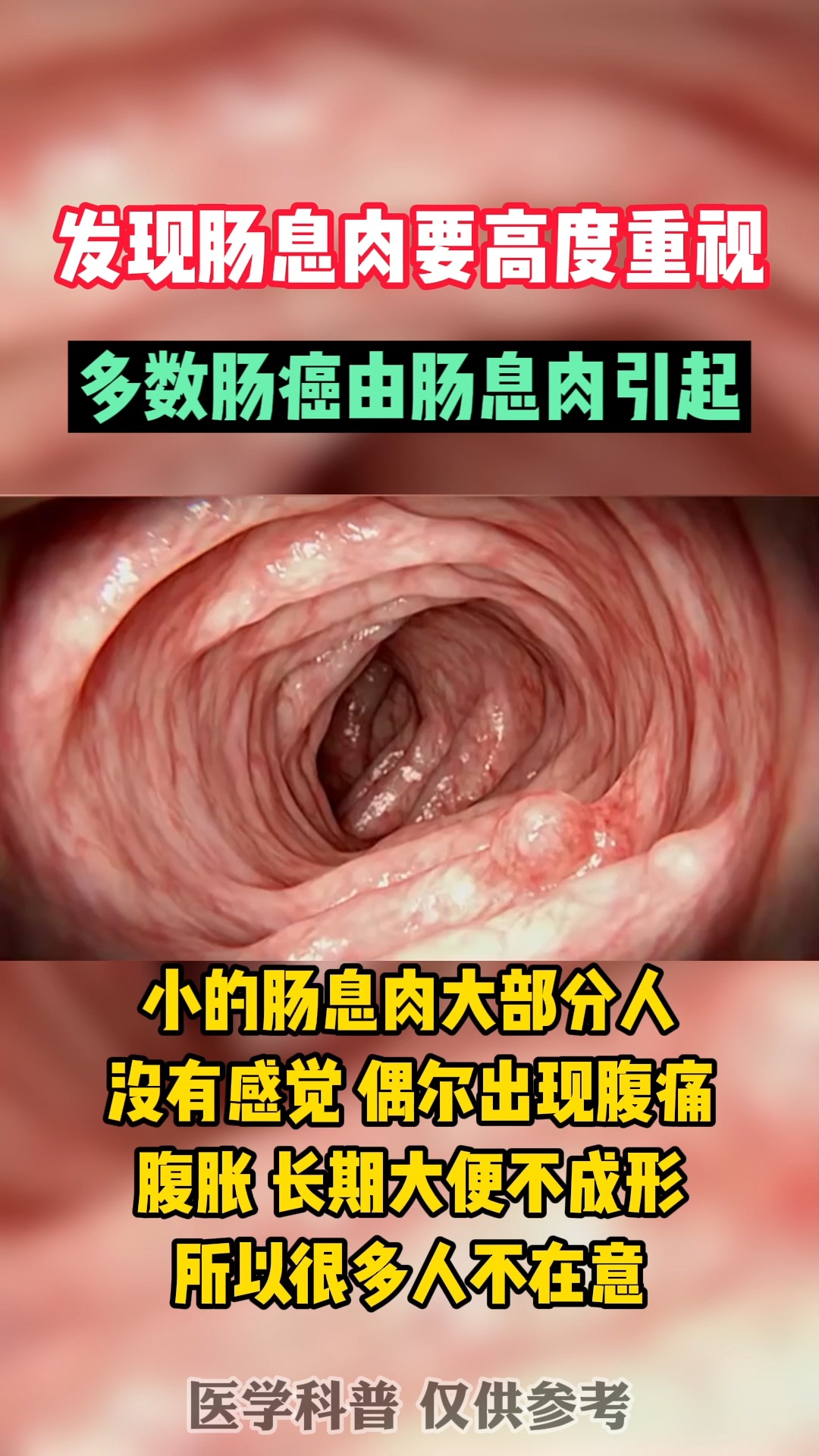 #每日健康推荐#发现肠息肉一定要高度重视,肠癌的信号!
