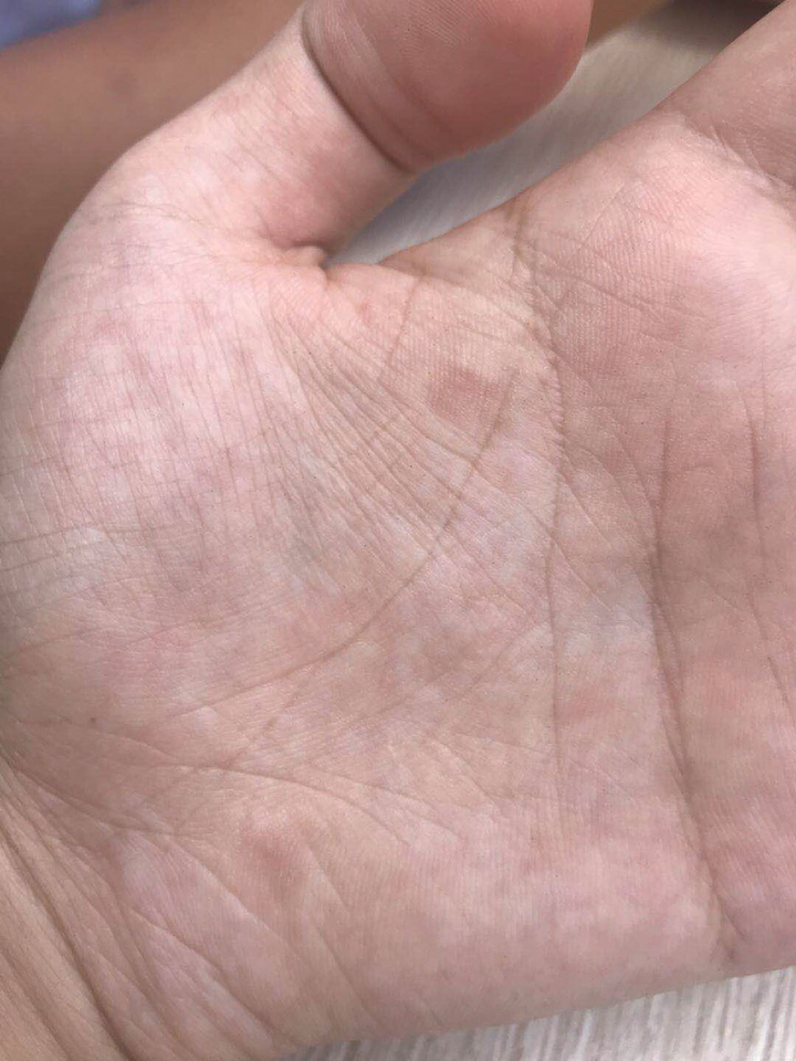 并不是鸡眼