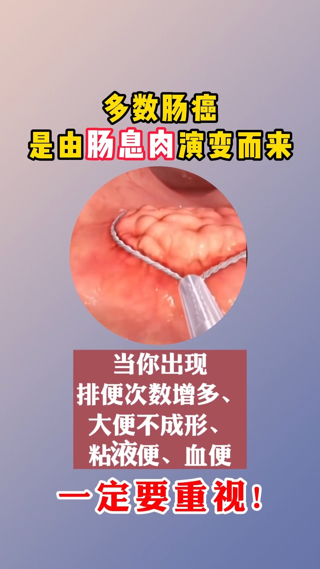 多数肠癌是由肠息肉演变而来