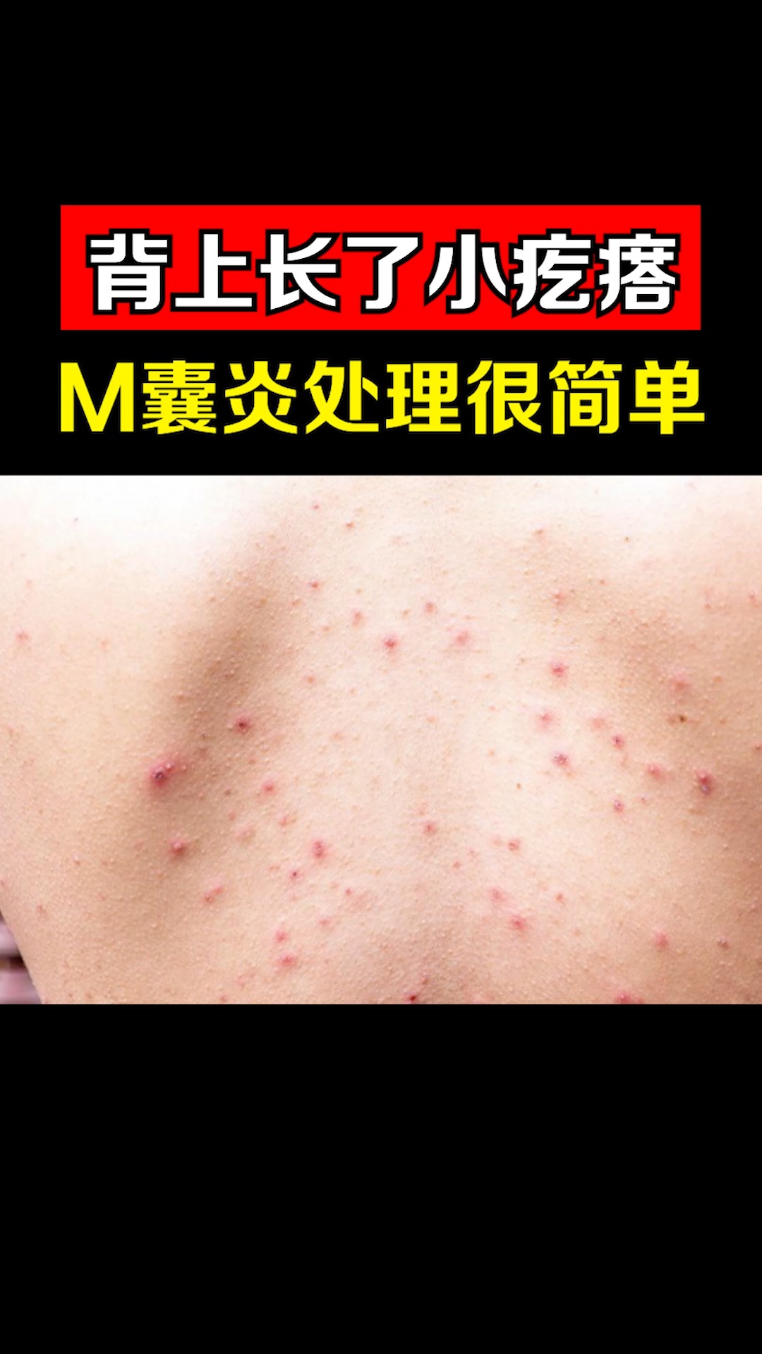 #南方健康#背上长了小疙瘩,毛囊炎处理很简单