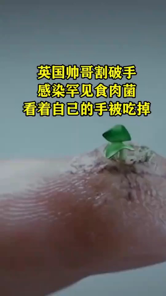 英国帅哥割破手感染罕见食肉菌看着自己的手被吃掉