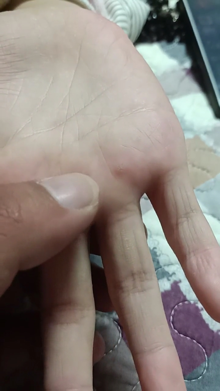 跖疣鸡眼可以这样搞