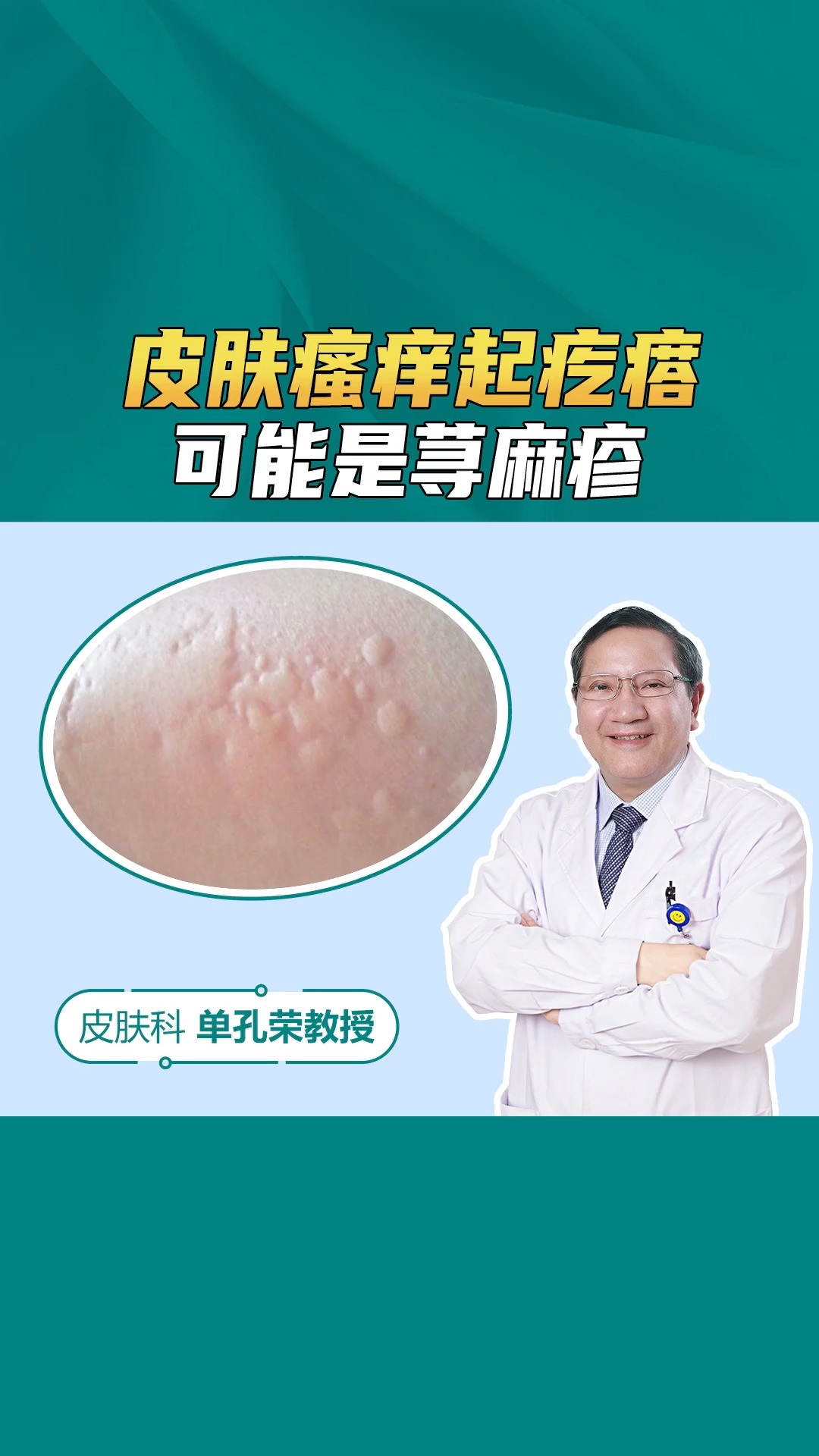 孩子皮肤瘙痒起疙瘩是怎么回事?当心是荨麻疹,单孔荣主任分享治疗方法帮助改善