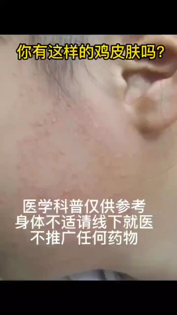#夏季养生堂#你是不是这种鸡皮肤,好消息来了可以治疗