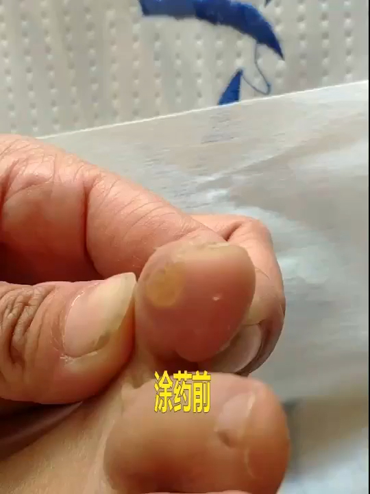 鸡眼刺猴