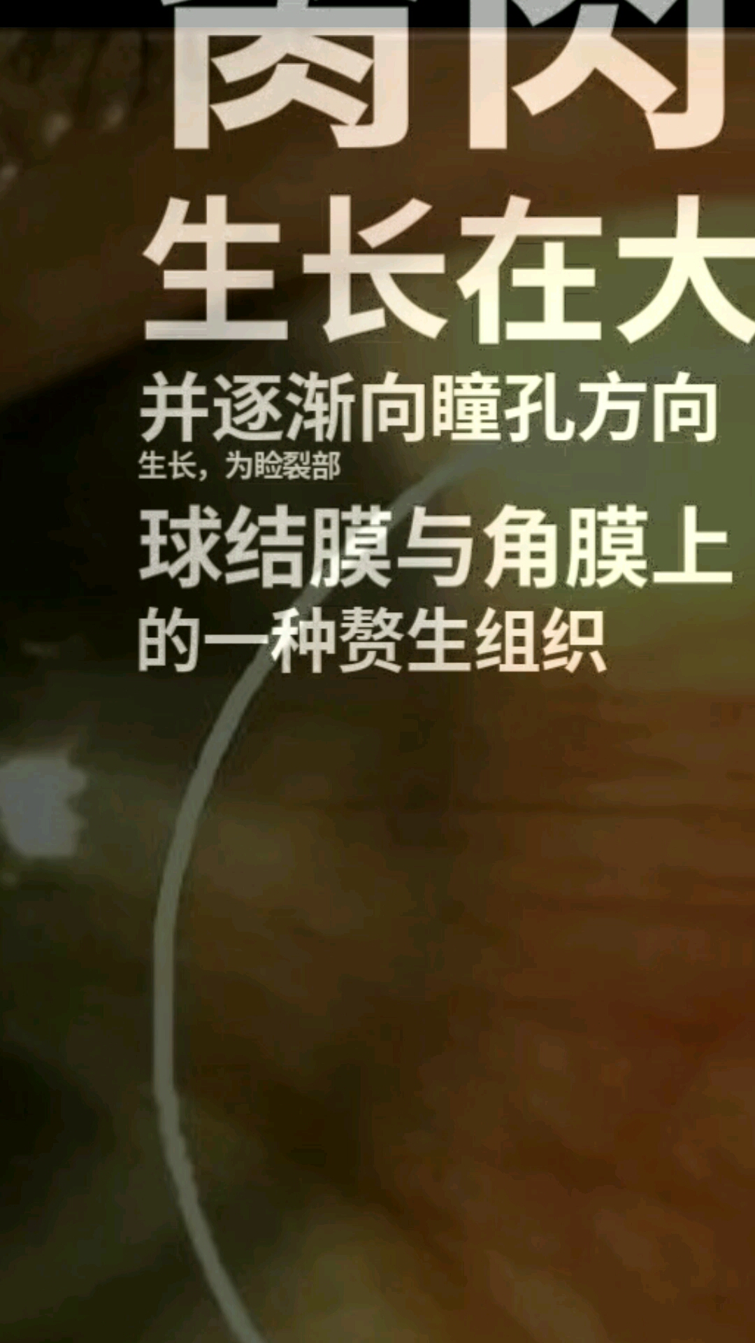 眼睛上为什么会长鱼肉?这是医学上所说的,翼状胬肉,中医称胬肉攀睛。