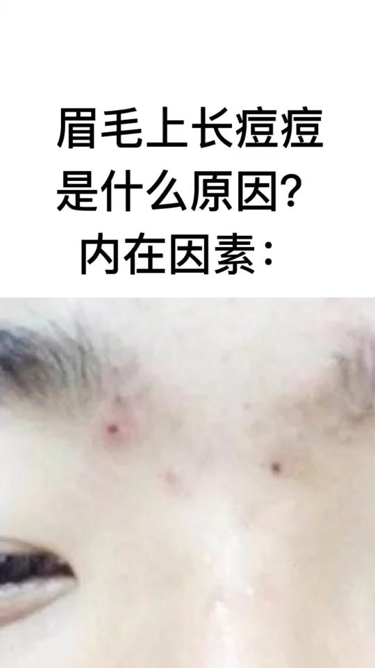 眉毛长痘痘的原因