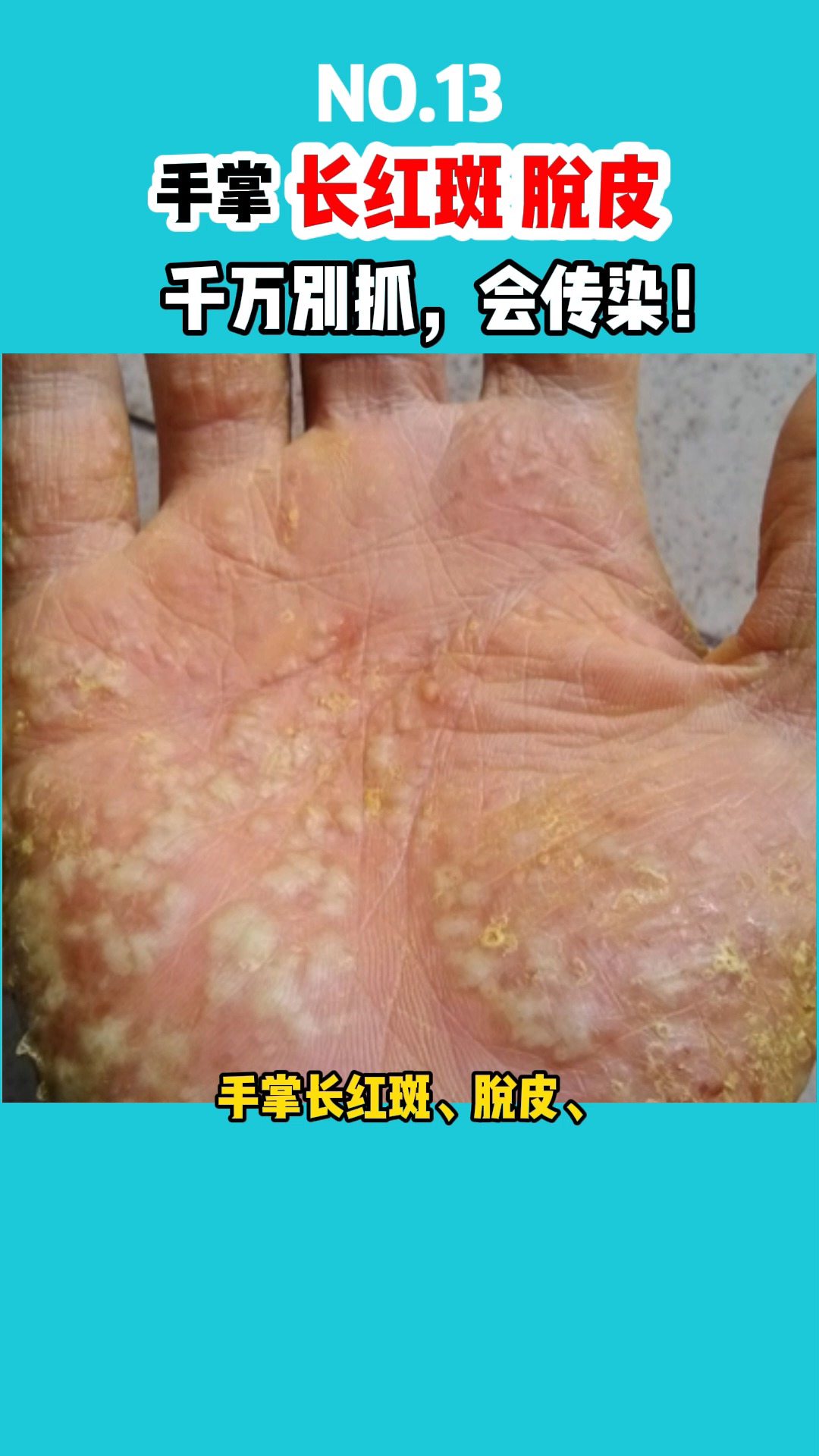 #皮肤病#手掌长红斑,脱皮,千万别抓,会传染!