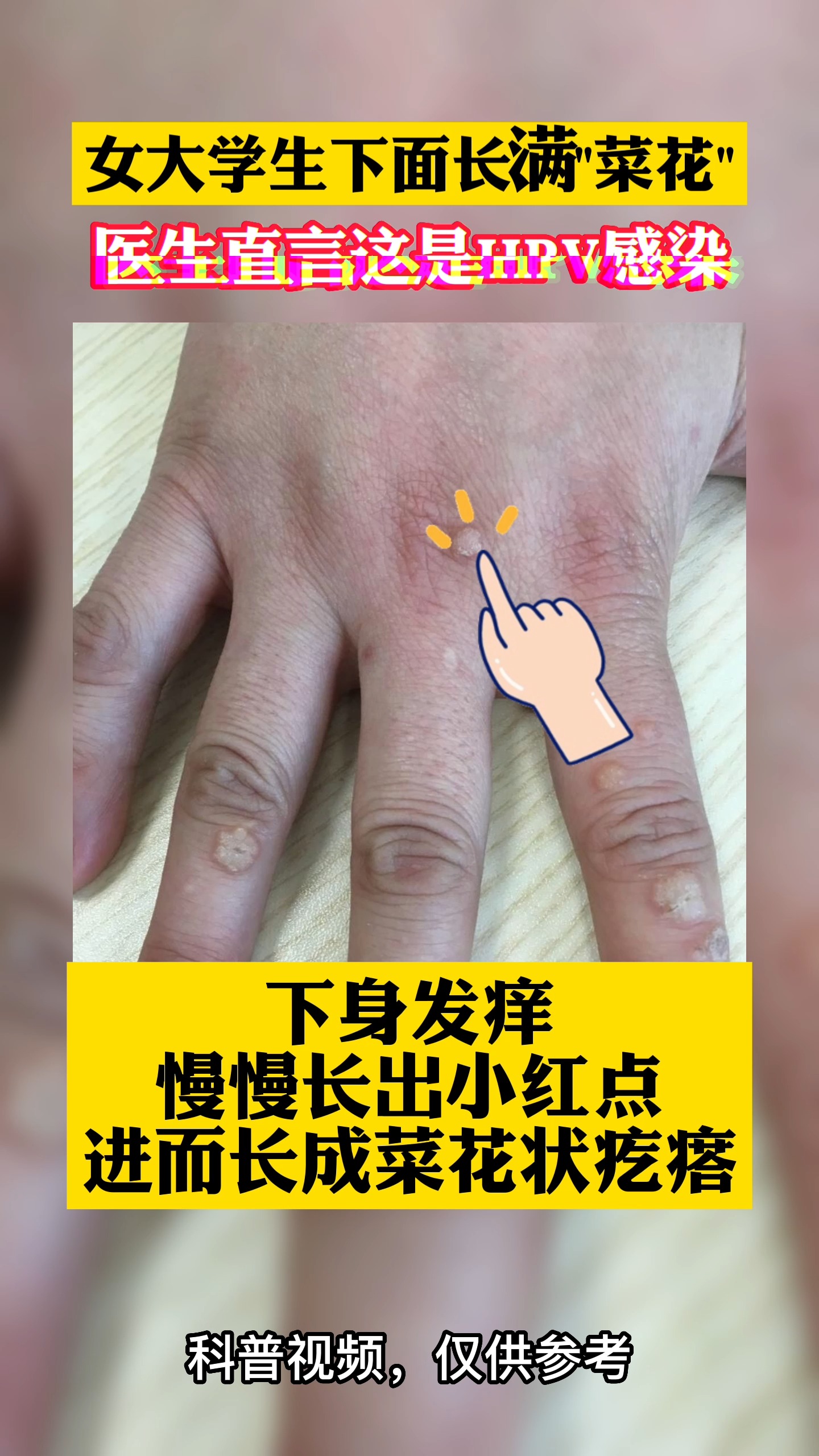 #关爱女性健康#下身长满”菜花状”疙瘩,可能是HPV感染