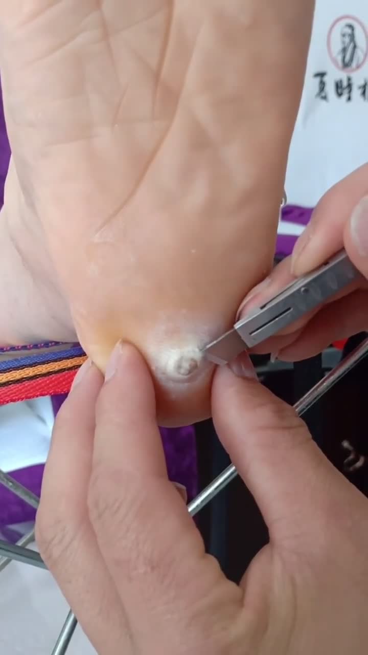 影视大咖秀:长鸡眼不是病疼起来真要命,走路都疼,去掉的那一瞬间是不是快好了