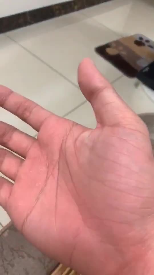 过敏,是这个样子的,全身奇痒无比,因为密恐其他就不发了,就因为我吃了几只小虾,晚餐喝的粥和