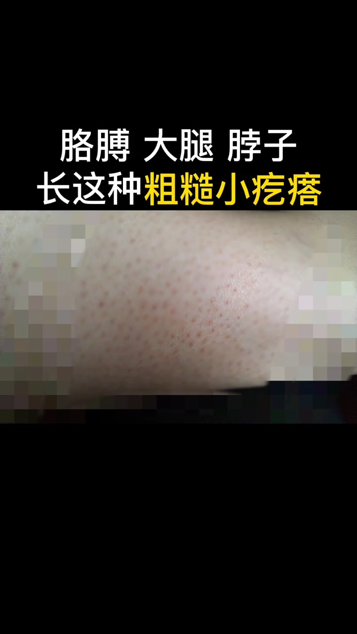 #鸡皮肤#鸡皮肤很难看，专家5秒教你解决！