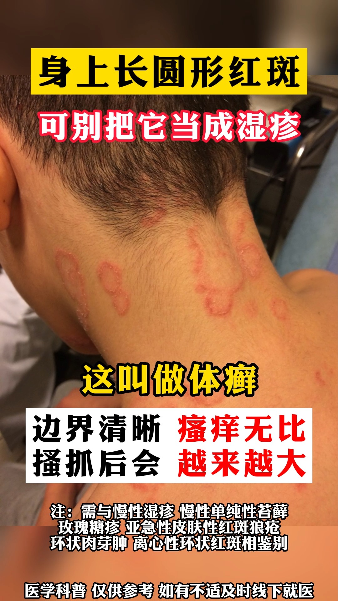 #健康科普#得了皮肤病要及时治疗